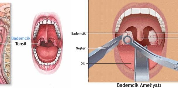 Tonsil and Adenoid - Op. Dr. Muhammet Dilber